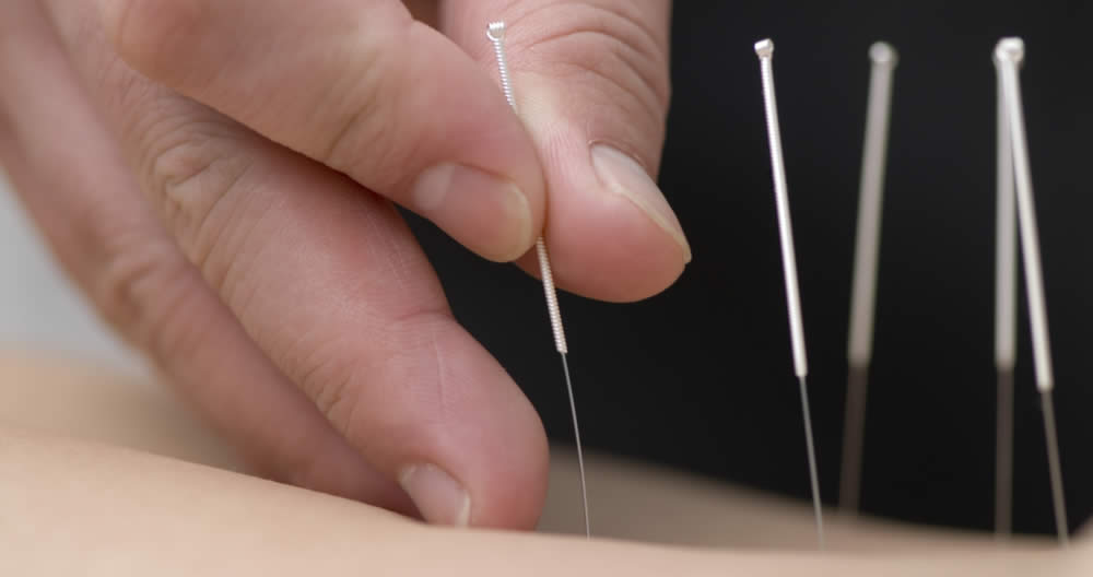 Acupuntura